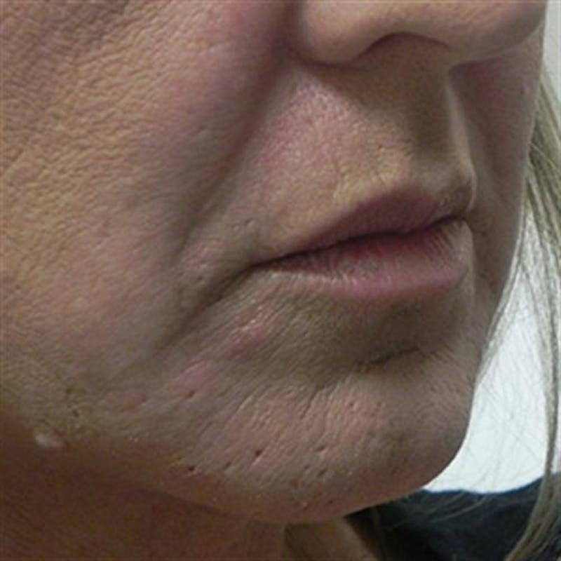 Lip Enhancement Before & After Gallery - Patient 130694 - Image 1