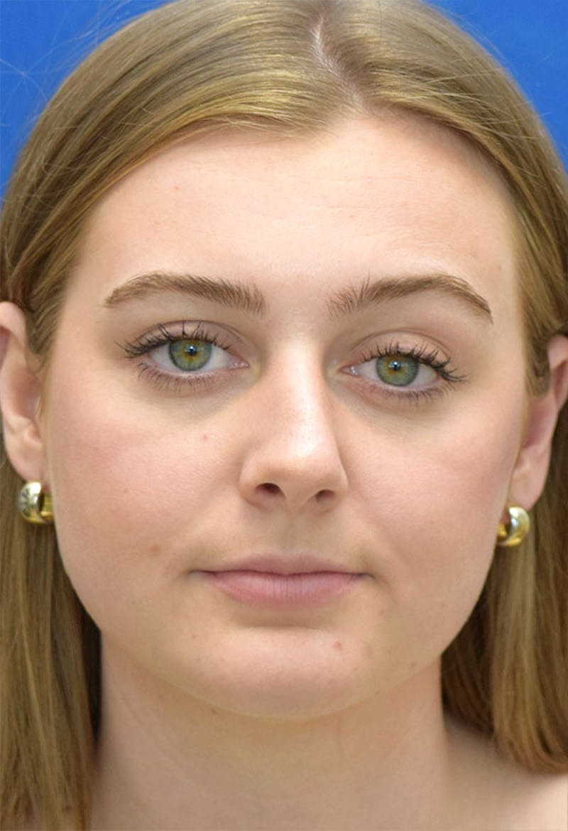 Rhinoplasty Before & After Gallery - Patient 141448 - Image 5