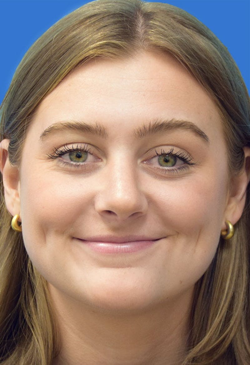 Rhinoplasty Before & After Gallery - Patient 141448 - Image 6