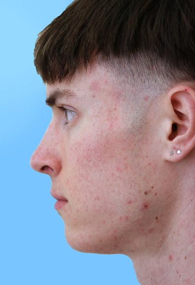 Rhinoplasty Before & After Gallery - Patient 399341 - Image 2