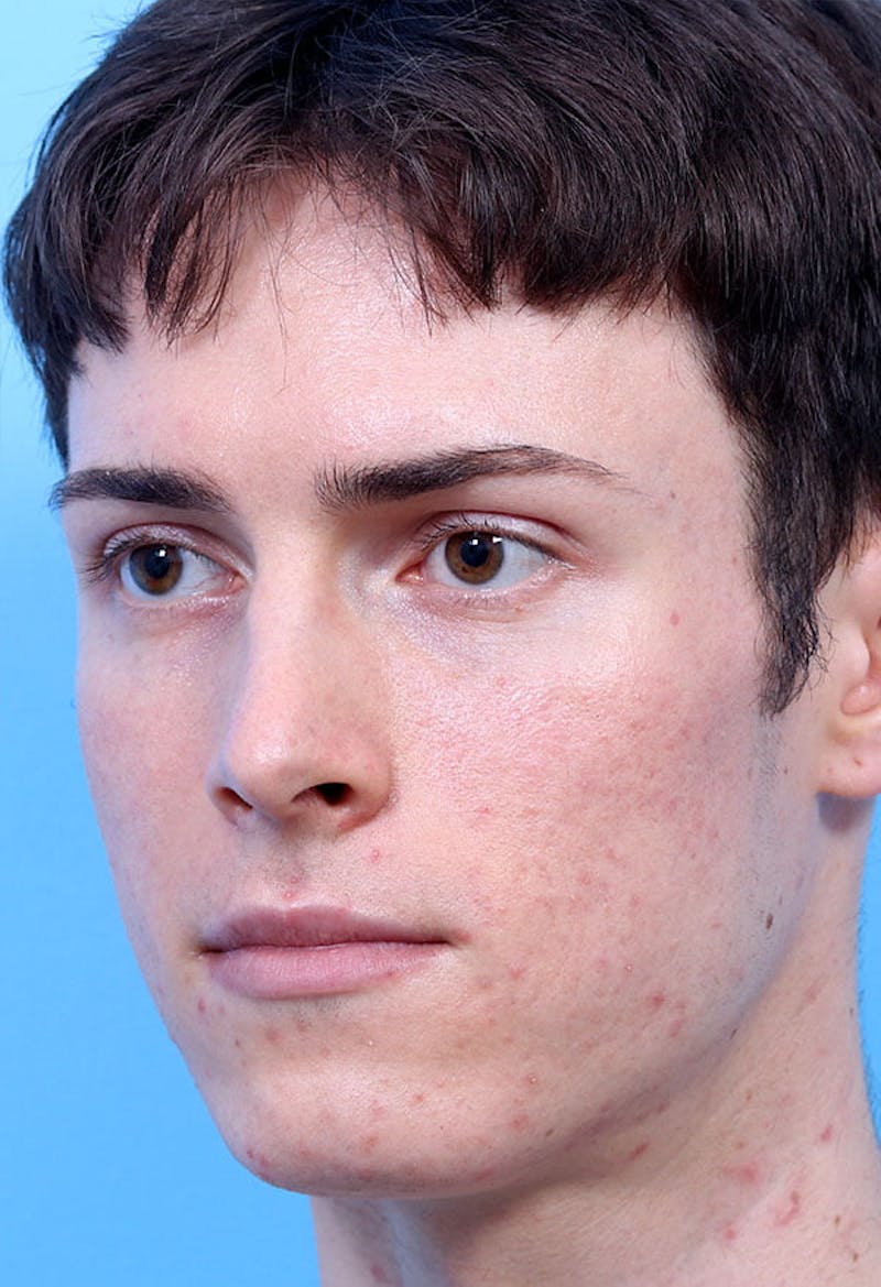 Rhinoplasty Before & After Gallery - Patient 399341 - Image 3