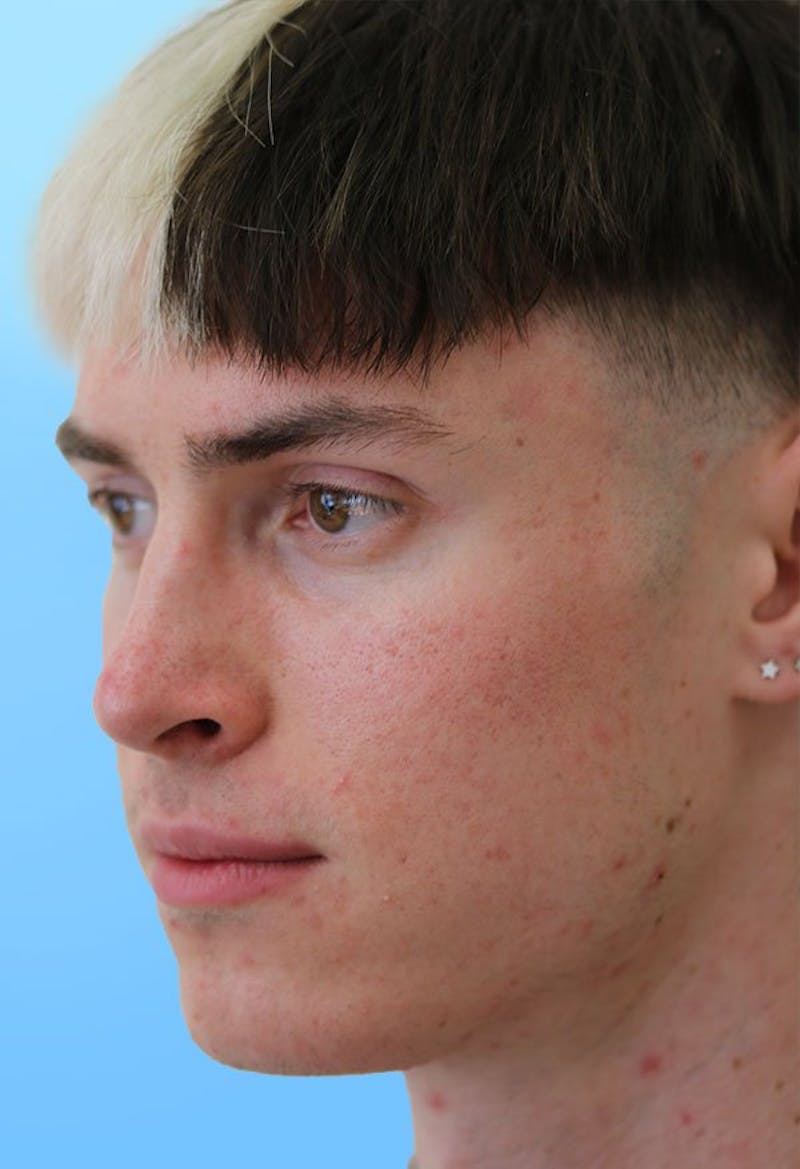 Rhinoplasty Before & After Gallery - Patient 399341 - Image 4