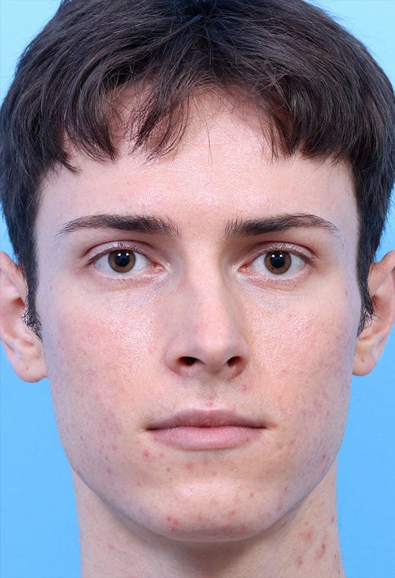 Rhinoplasty Before & After Gallery - Patient 399341 - Image 5