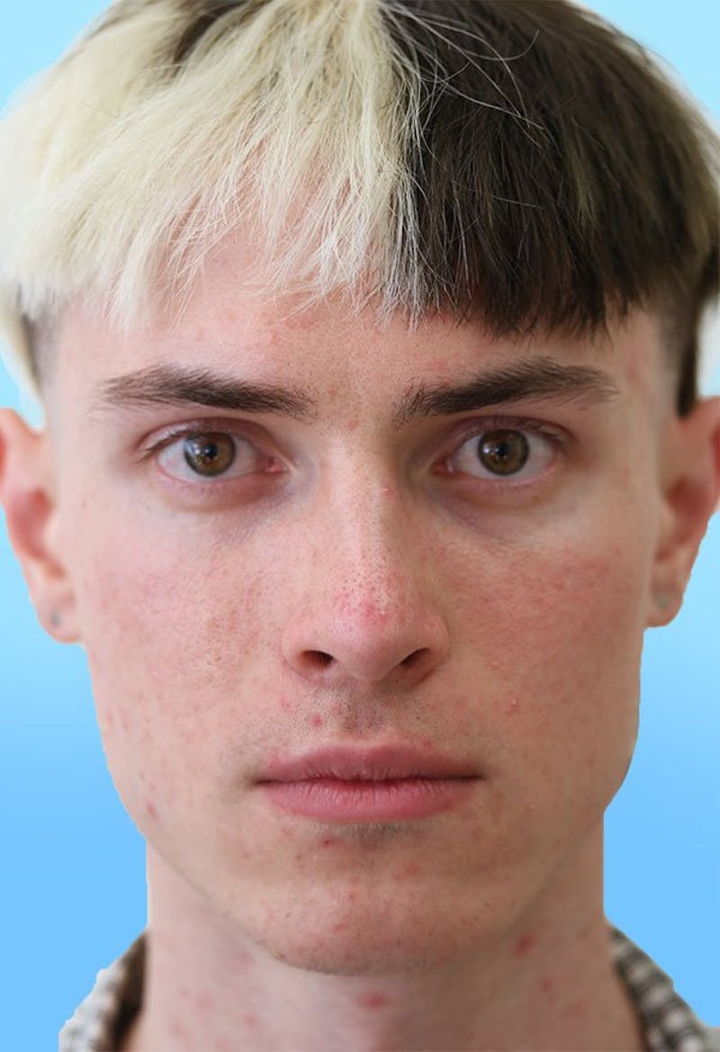 Rhinoplasty Before & After Gallery - Patient 399341 - Image 6