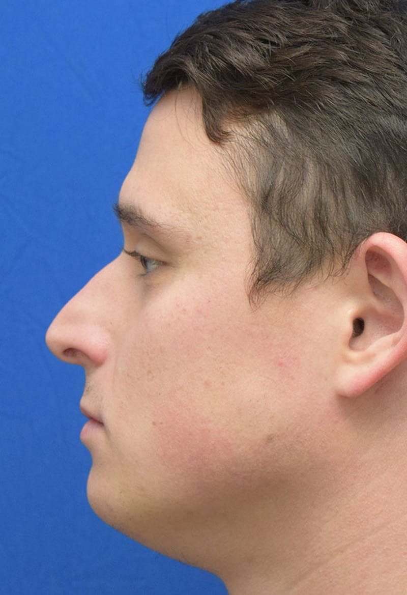 Rhinoplasty Before & After Gallery - Patient 679474 - Image 1