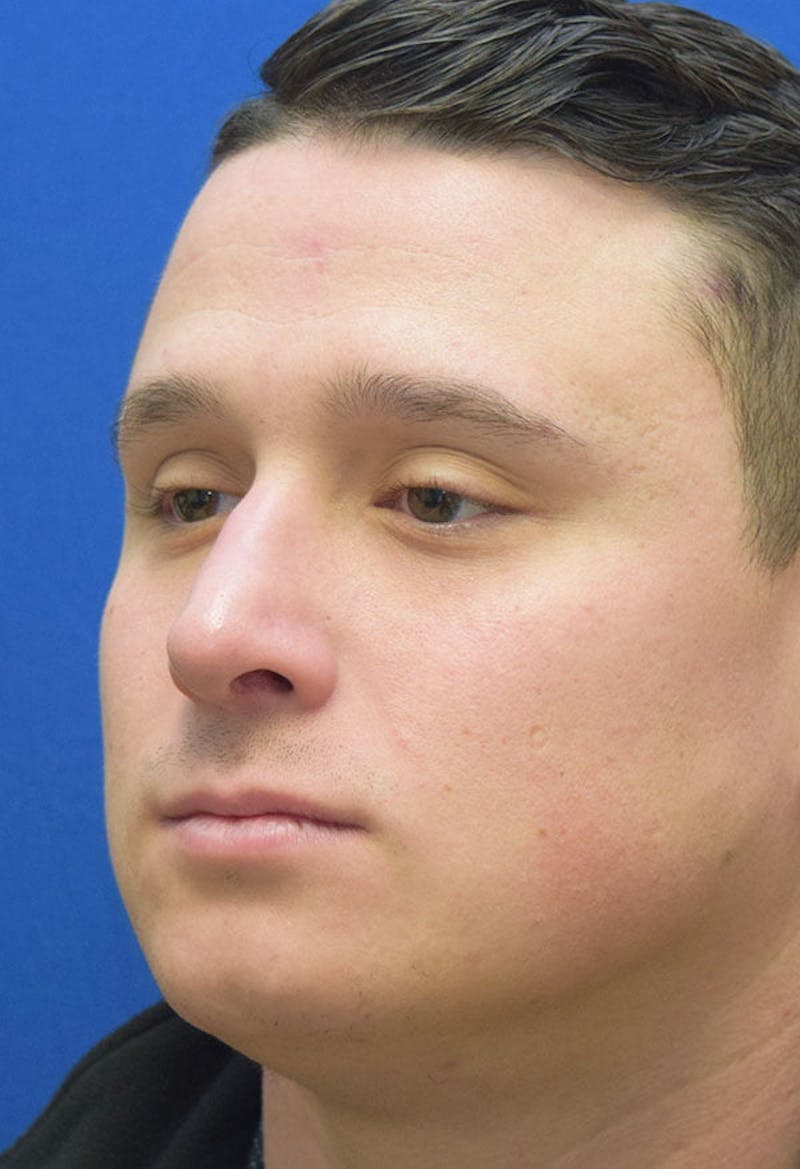 Rhinoplasty Before & After Gallery - Patient 679474 - Image 4