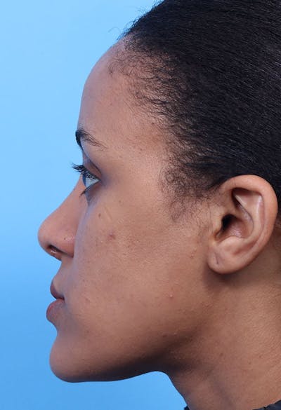 Rhinoplasty Before & After Gallery - Patient 125901 - Image 2
