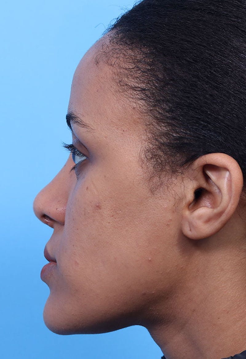 Rhinoplasty Before & After Gallery - Patient 125901 - Image 2