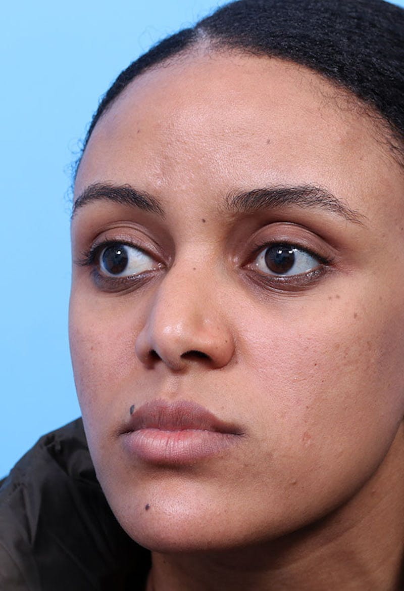 Rhinoplasty Before & After Gallery - Patient 125901 - Image 3