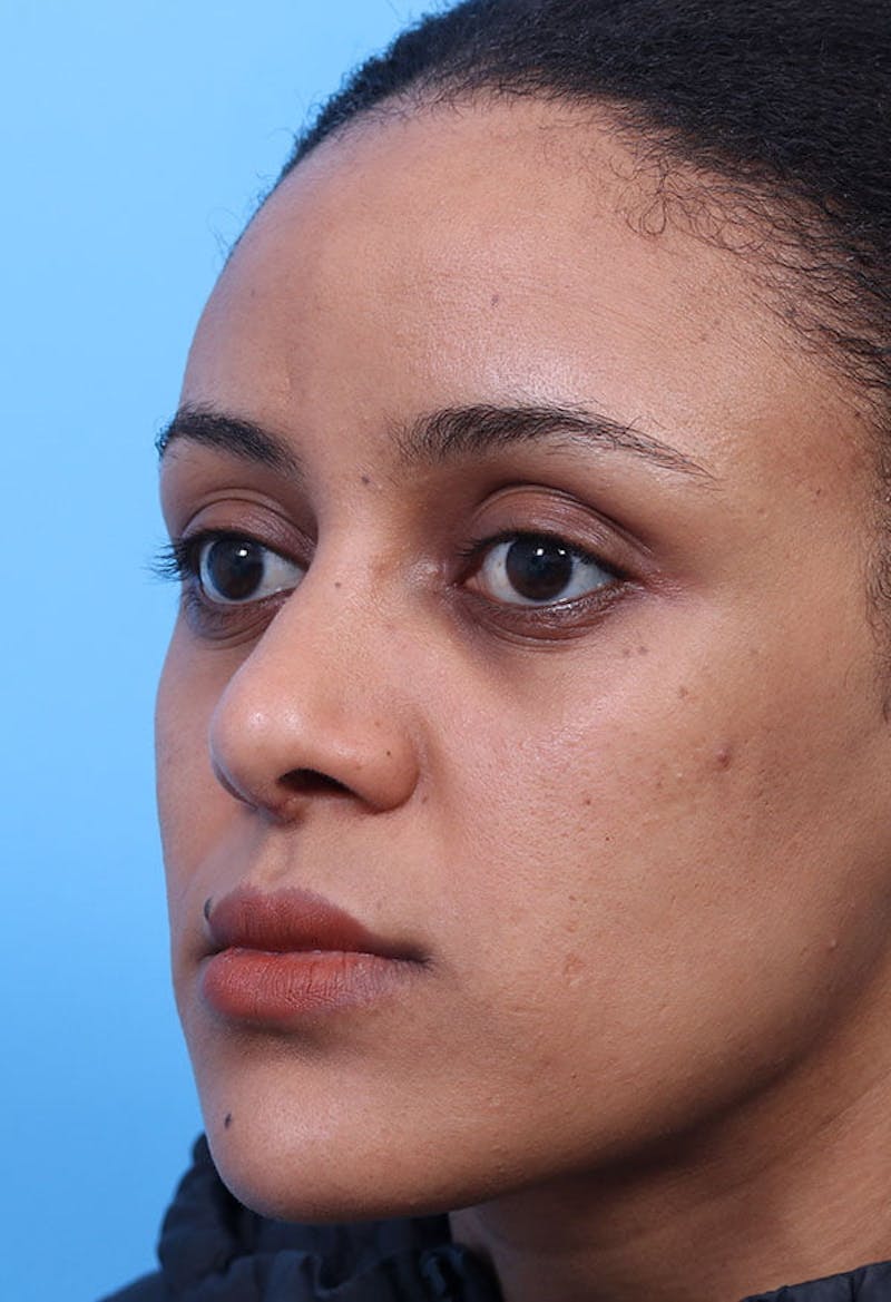 Rhinoplasty Before & After Gallery - Patient 125901 - Image 4