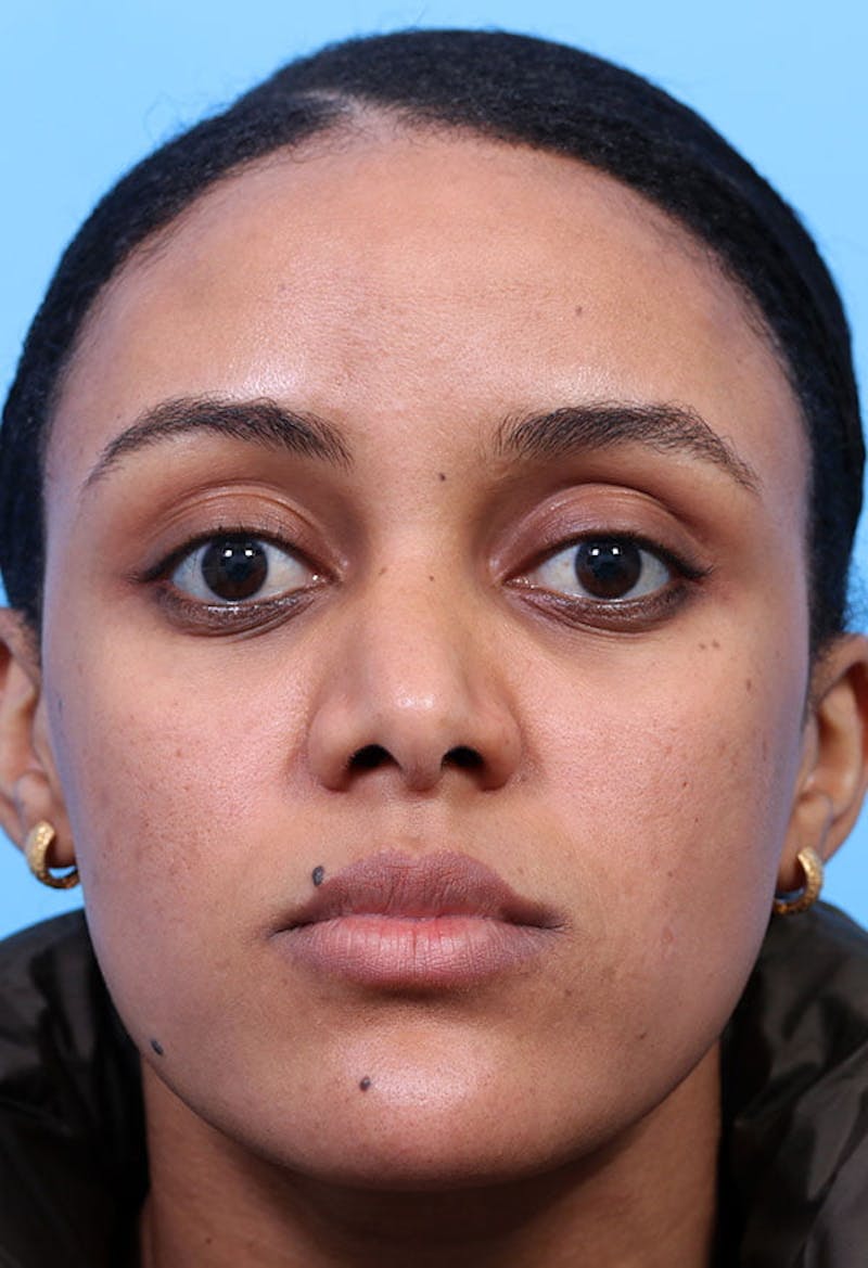 Rhinoplasty Before & After Gallery - Patient 125901 - Image 5