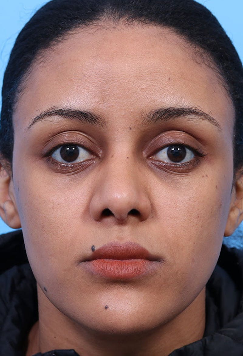Rhinoplasty Before & After Gallery - Patient 125901 - Image 6