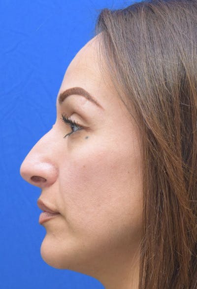 Rhinoplasty Before & After Gallery - Patient 413152 - Image 1