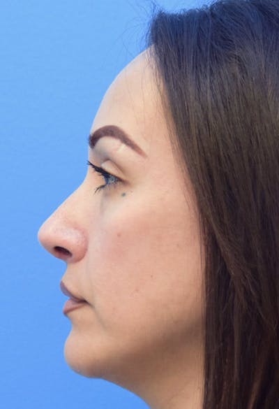 Rhinoplasty Before & After Gallery - Patient 413152 - Image 2