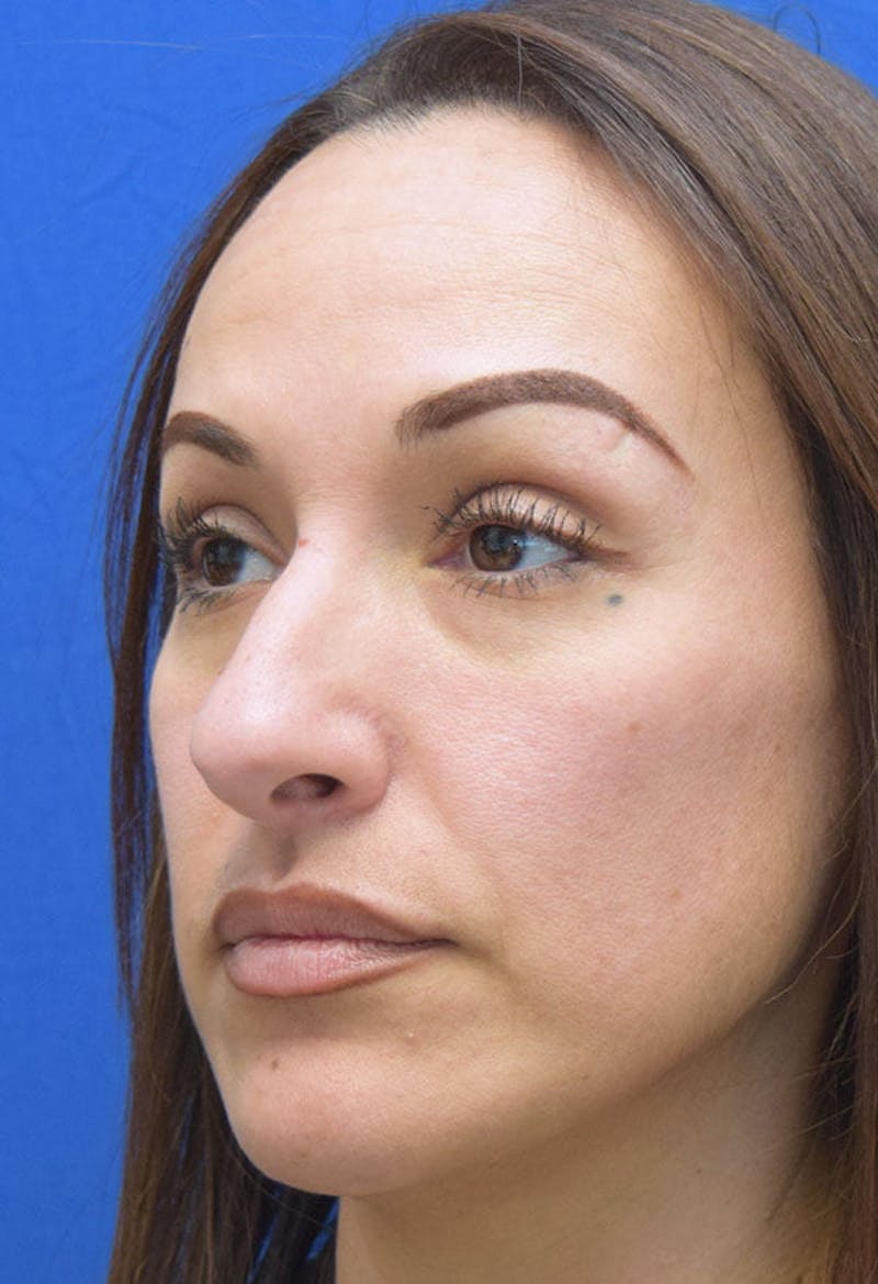 Rhinoplasty Before & After Gallery - Patient 413152 - Image 3