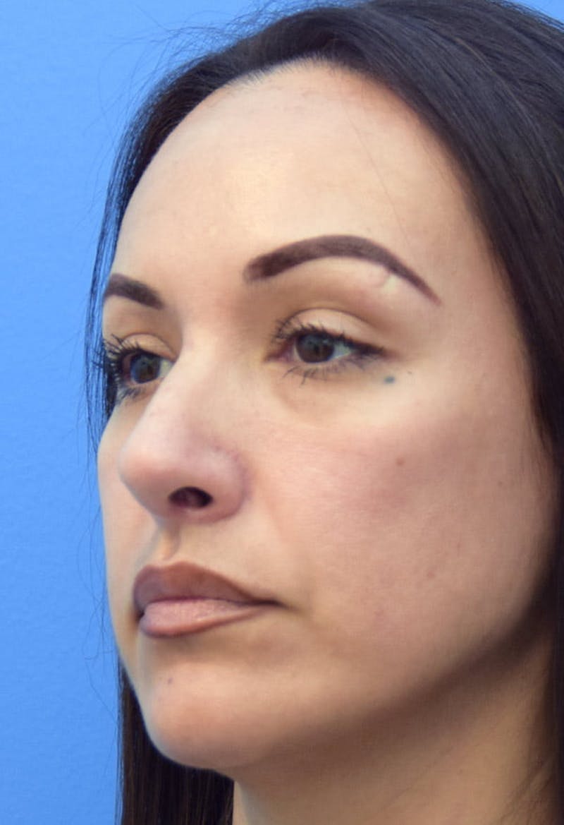 Rhinoplasty Before & After Gallery - Patient 413152 - Image 4