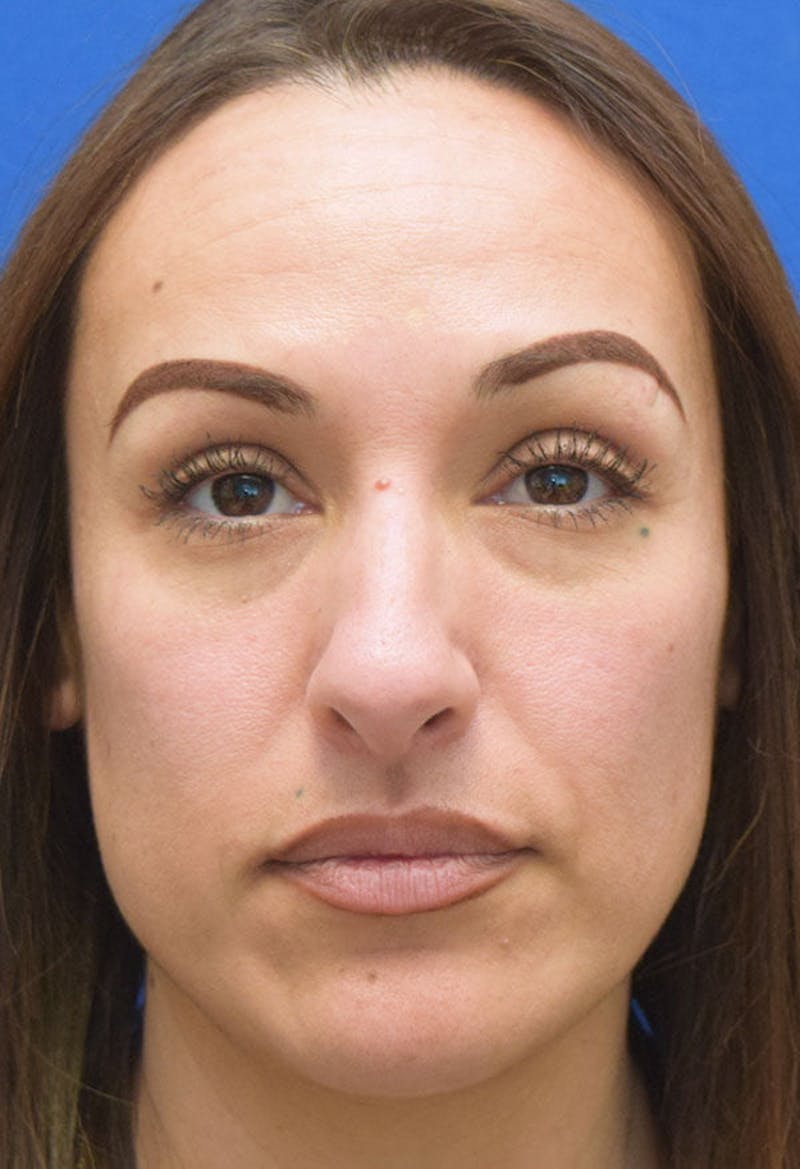 Rhinoplasty Before & After Gallery - Patient 413152 - Image 5