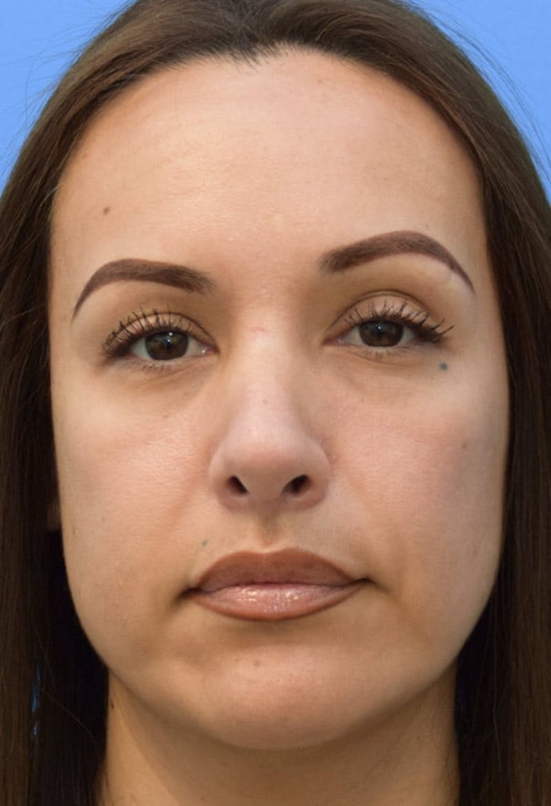 Rhinoplasty Before & After Gallery - Patient 413152 - Image 6
