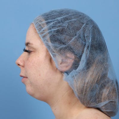 Chin Augmentation Before & After Gallery - Patient 400101 - Image 1