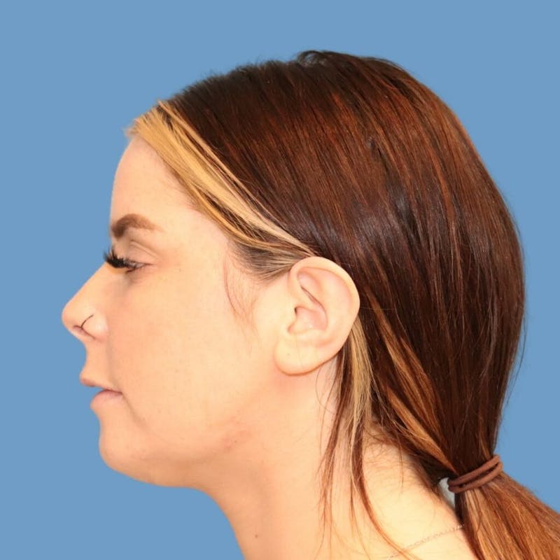 Chin Augmentation Before & After Gallery - Patient 400101 - Image 2