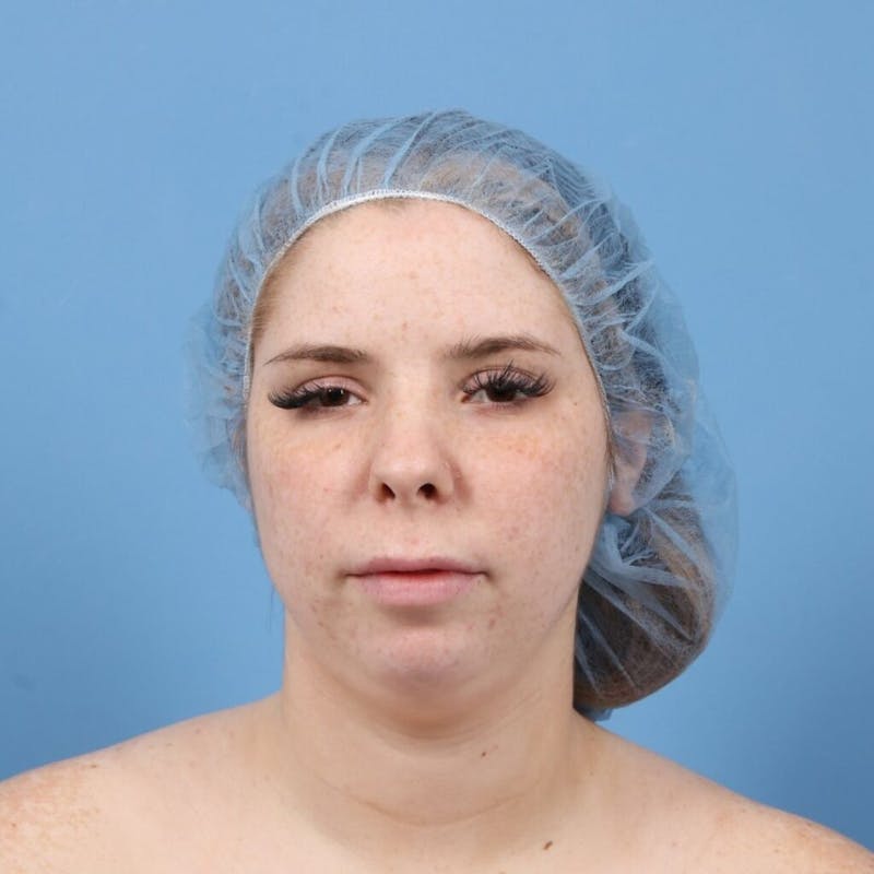 Chin Augmentation Before & After Gallery - Patient 400101 - Image 3