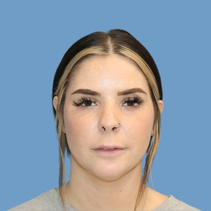 Chin Augmentation Before & After Gallery - Patient 400101 - Image 4