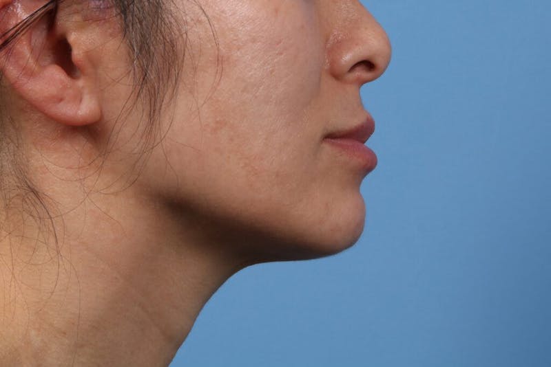 Chin Augmentation Before & After Gallery - Patient 295955 - Image 1
