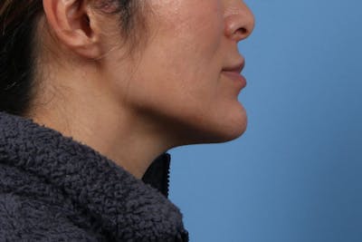 Chin Augmentation Before & After Gallery - Patient 295955 - Image 2