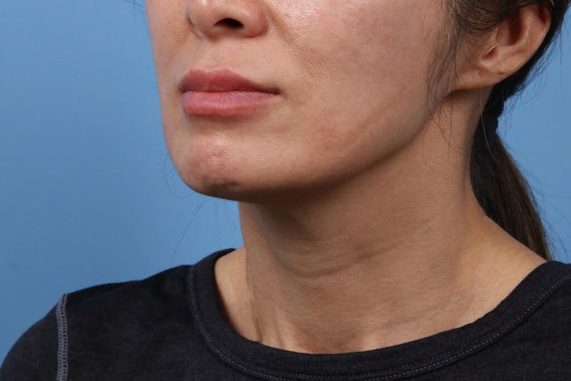 Chin Augmentation Before & After Gallery - Patient 295955 - Image 3