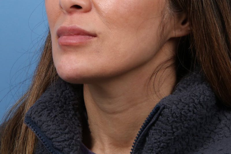 Chin Augmentation Before & After Gallery - Patient 295955 - Image 4