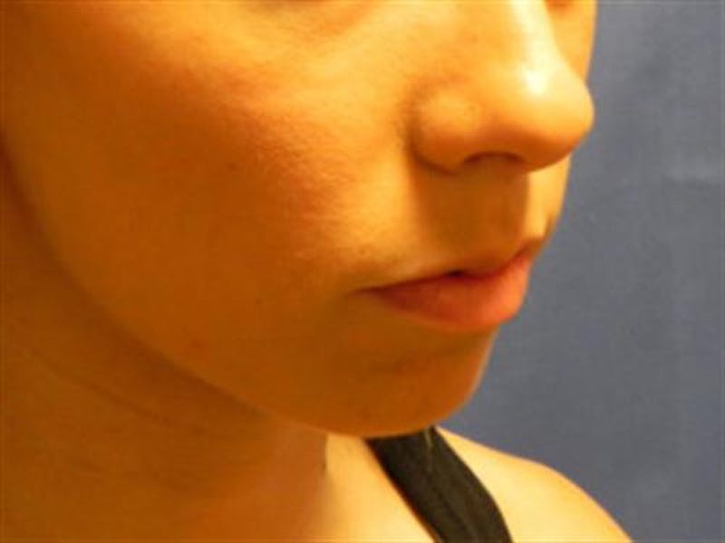 Chin Augmentation Before & After Gallery - Patient 349557 - Image 3