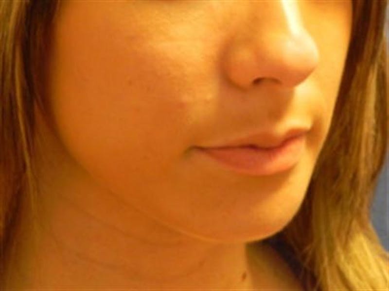 Chin Augmentation Before & After Gallery - Patient 349557 - Image 4
