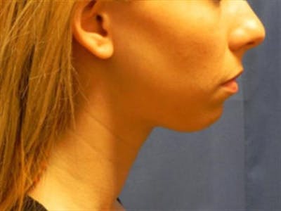 Chin Augmentation Before & After Gallery - Patient 349557 - Image 1