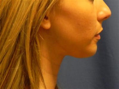 Chin Augmentation Before & After Gallery - Patient 349557 - Image 2