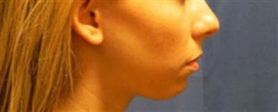 Chin Augmentation Before & After Gallery - Patient 251971 - Image 1
