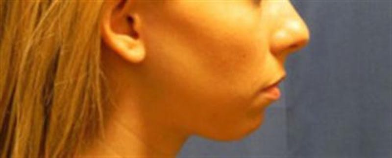 Chin Augmentation Before & After Gallery - Patient 251971 - Image 1