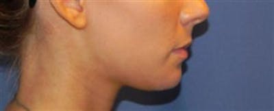 Chin Augmentation Before & After Gallery - Patient 251971 - Image 2
