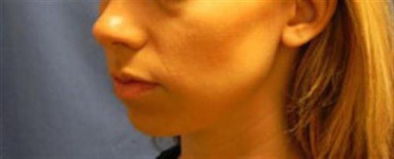 Chin Augmentation Before & After Gallery - Patient 251971 - Image 3