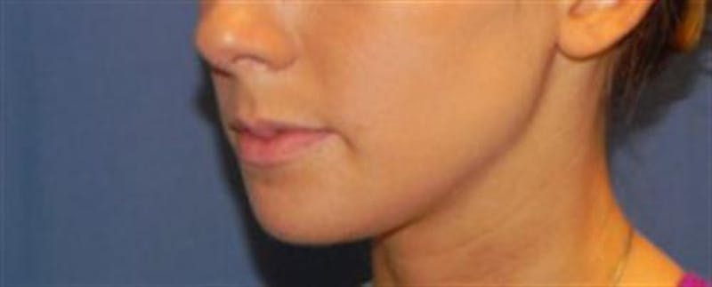 Chin Augmentation Before & After Gallery - Patient 251971 - Image 4