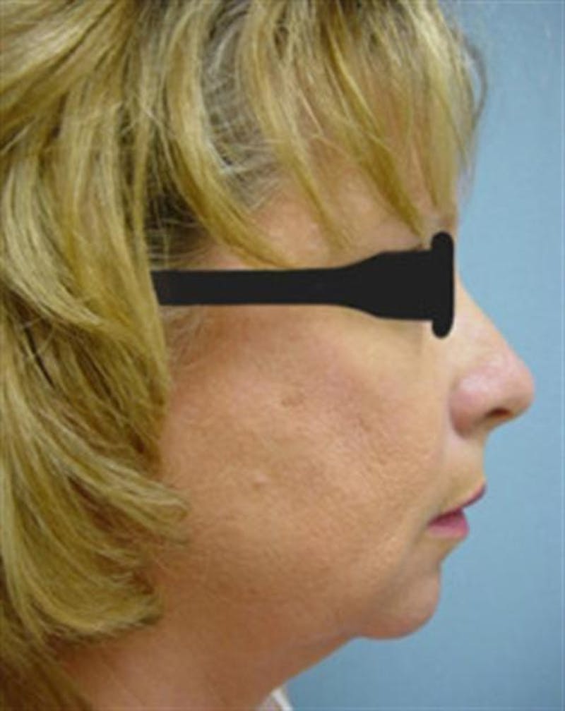 Chin Augmentation Before & After Gallery - Patient 193334 - Image 3