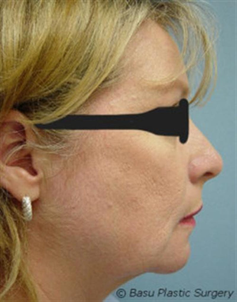 Chin Augmentation Before & After Gallery - Patient 193334 - Image 4