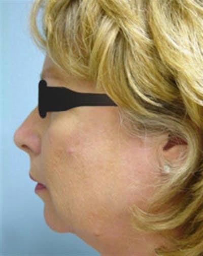 Chin Augmentation Before & After Gallery - Patient 193334 - Image 1