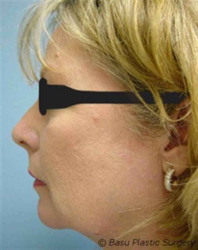 Chin Augmentation Before & After Gallery - Patient 193334 - Image 2