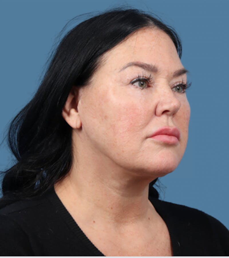 FaceTite / NeckTite Before & After Gallery - Patient 608439 - Image 4