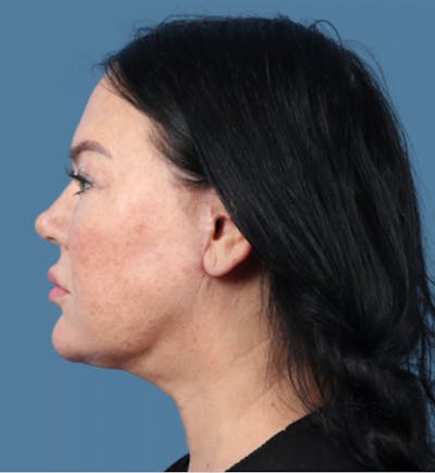FaceTite / NeckTite Before & After Gallery - Patient 608439 - Image 2