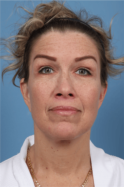 FaceTite / NeckTite Before & After Gallery - Patient 146758 - Image 2