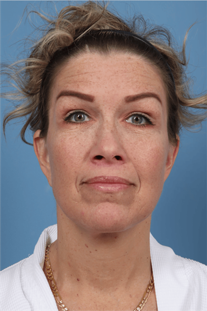 FaceTite / NeckTite Before & After Gallery - Patient 146758 - Image 2