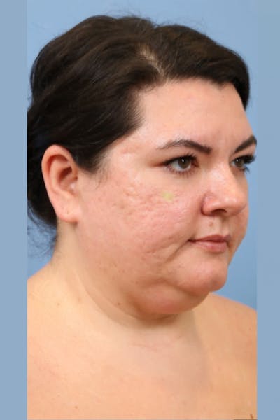 FaceTite / NeckTite Before & After Gallery - Patient 304871 - Image 1