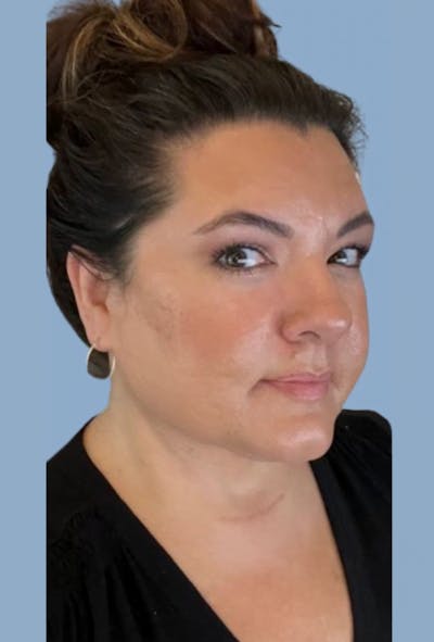 FaceTite / NeckTite Before & After Gallery - Patient 304871 - Image 2