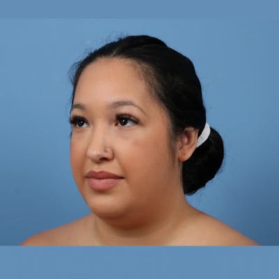 FaceTite / NeckTite Before & After Gallery - Patient 275300 - Image 1